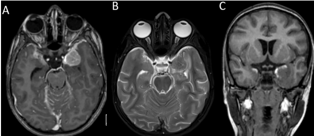 Read more about the article Primary diffuse leptomeningeal melanomatosis in a child with a clinical presentation mimicking meningitis: case report and review of literature
