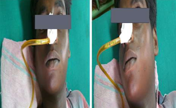 Read more about the article A Curious CA use of Pancreatitis -A Case Report